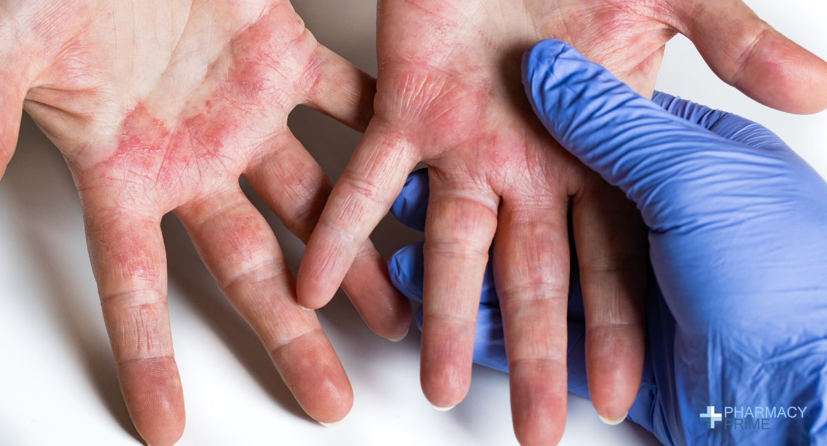 Contact Dermatitis